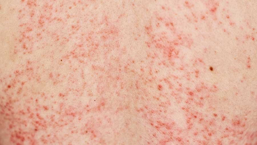 Tips Mudik Sehat dari Kemenkes di Tengah KLB Campak: Jangan Sampai Libur Lebaran Berujung Sakit!